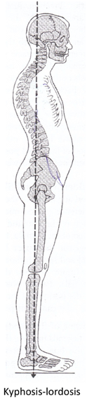 Kyphosis-lordosis posture
