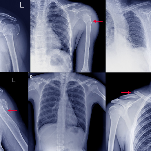 shoulder dislocation