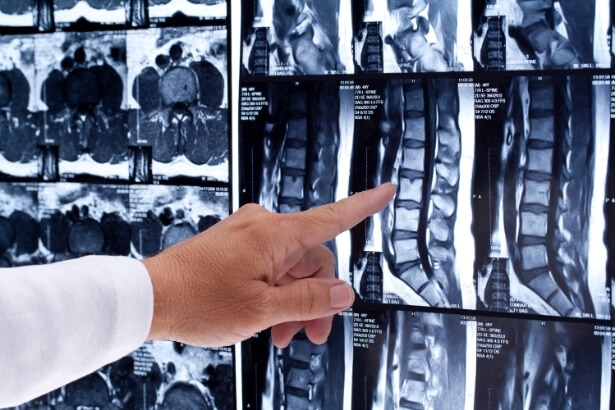 Hand pointing at spinal medical imaging on a screen, emphasising the need for expert interpretation of MRI or X-ray results.