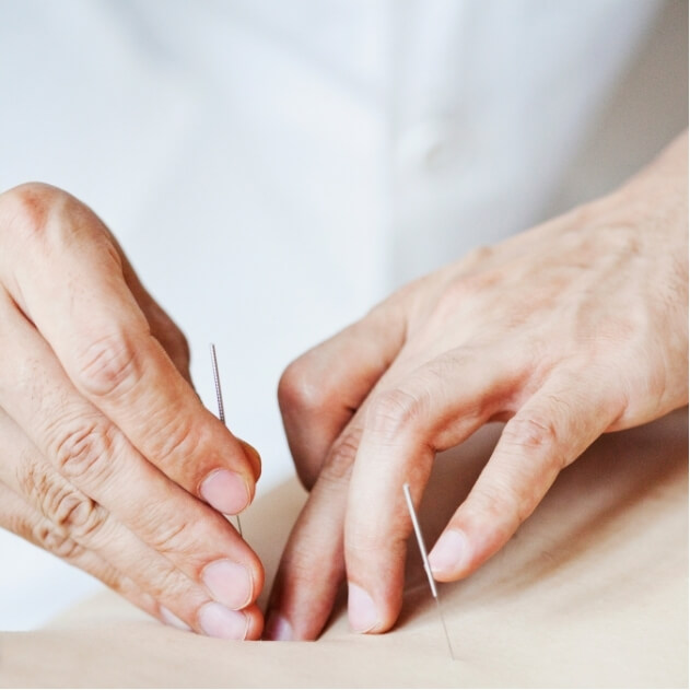 Physiotherapist performing dry needling by inserting fine needles into a patient’s back to treat muscular pain.