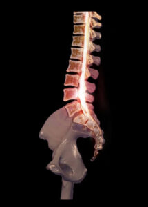 3D medical illustration of lumbar spine showing disc bulge visible on a lower back scan.
