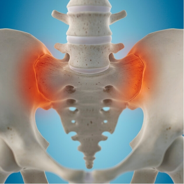 3D illustration highlighting sacroiliac joint pain in the pelvis.