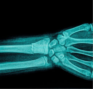 X-ray assessment for wrist pain after a fall