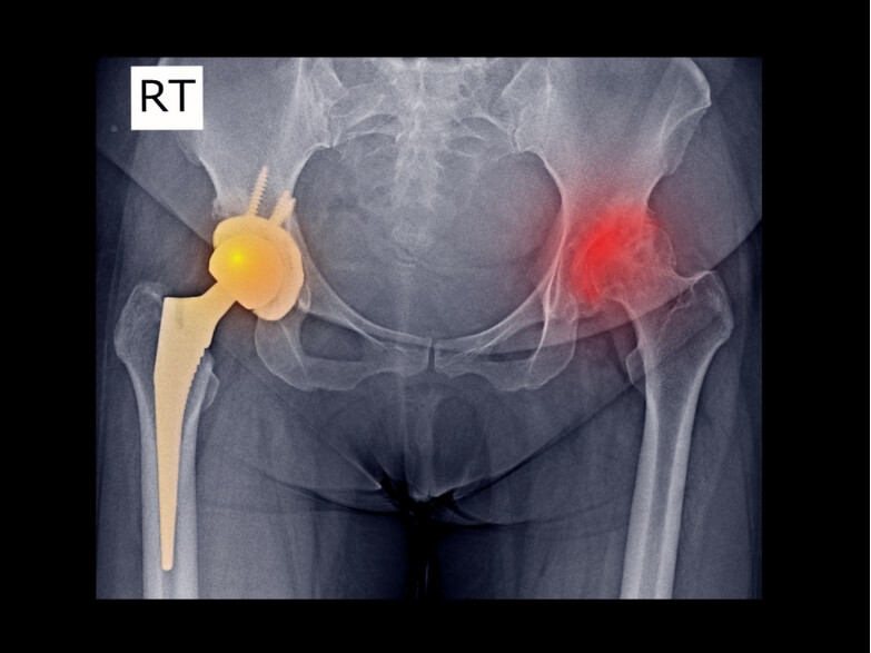 xray showing hip joint replacement relevant to bilateral hip replacement physiotherapy recovery