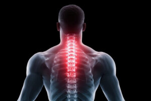 Illustration of the neck and upper back showing how cervical spine and shoulder dysfunction may contribute to elbow pain.