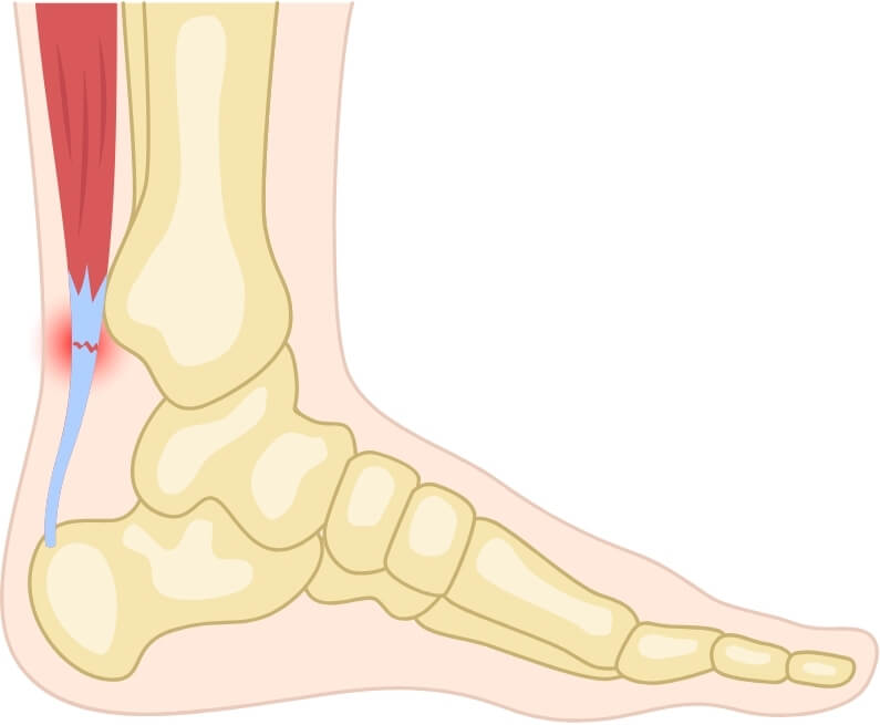 Illustration of the Achilles tendon at the back of the ankle with a red highlighted area showing tendon pain.